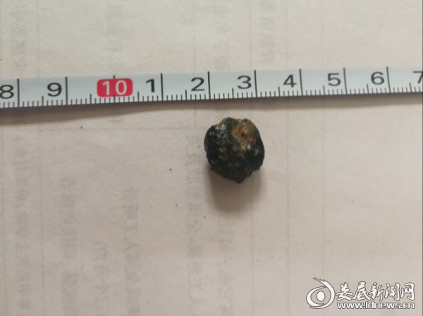 (胡金华老人腿部取出的1cm弹片)