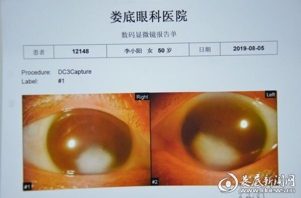 眼表照相报告单