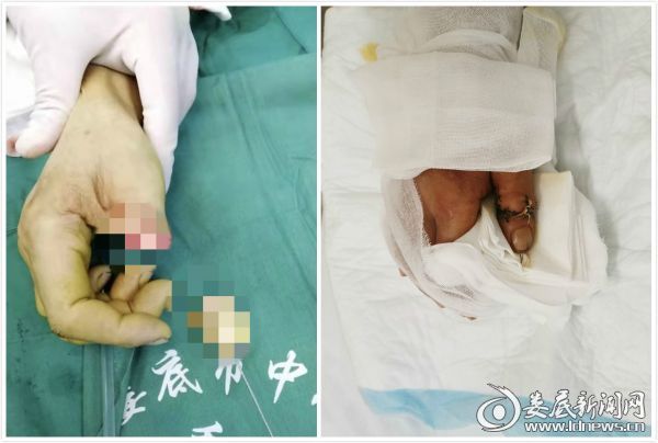 （术前术后对比）