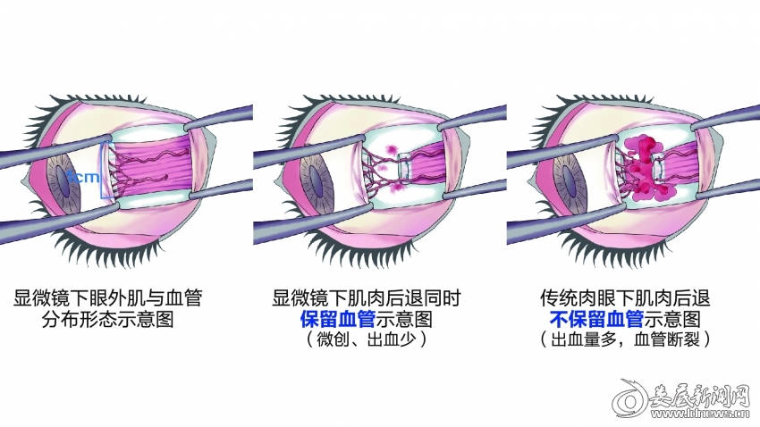 ▲显微镜下微创斜视手术优点