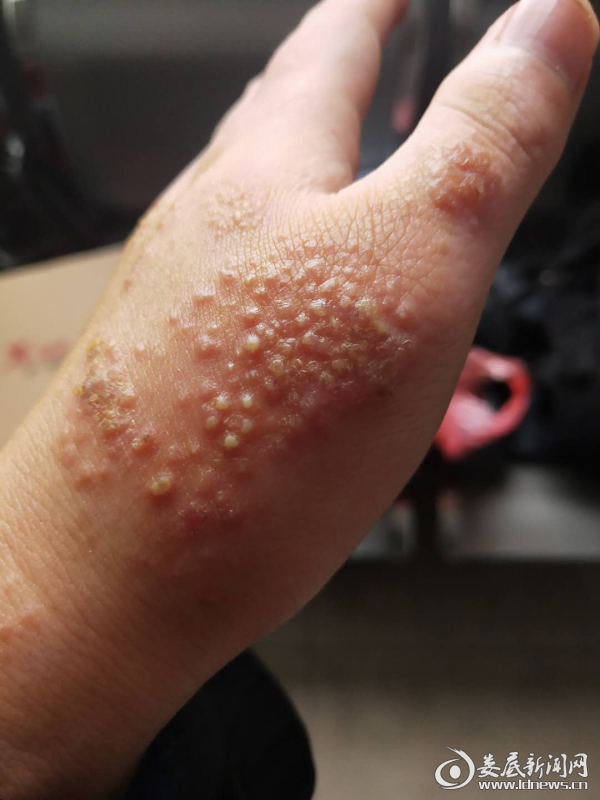 冷水江市90后医生方小武溃烂双手背后的抗疫决心