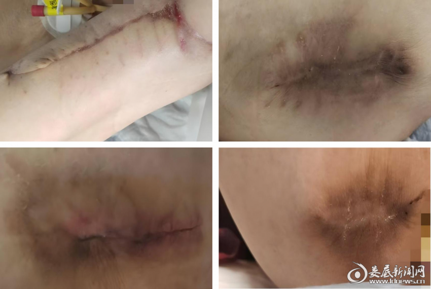 创面愈合后